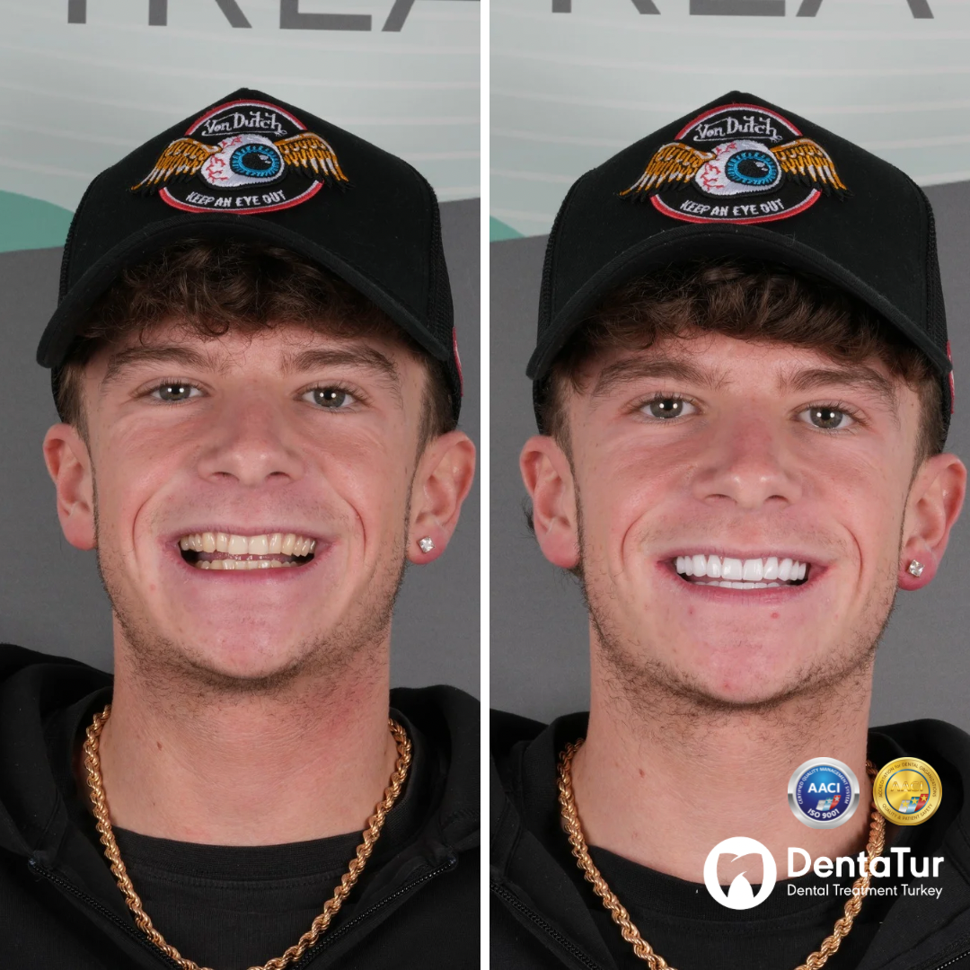 Dental veneers before and after
