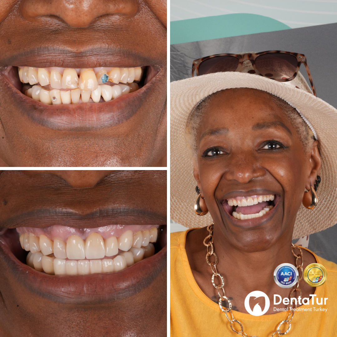 Dental crowns before and after