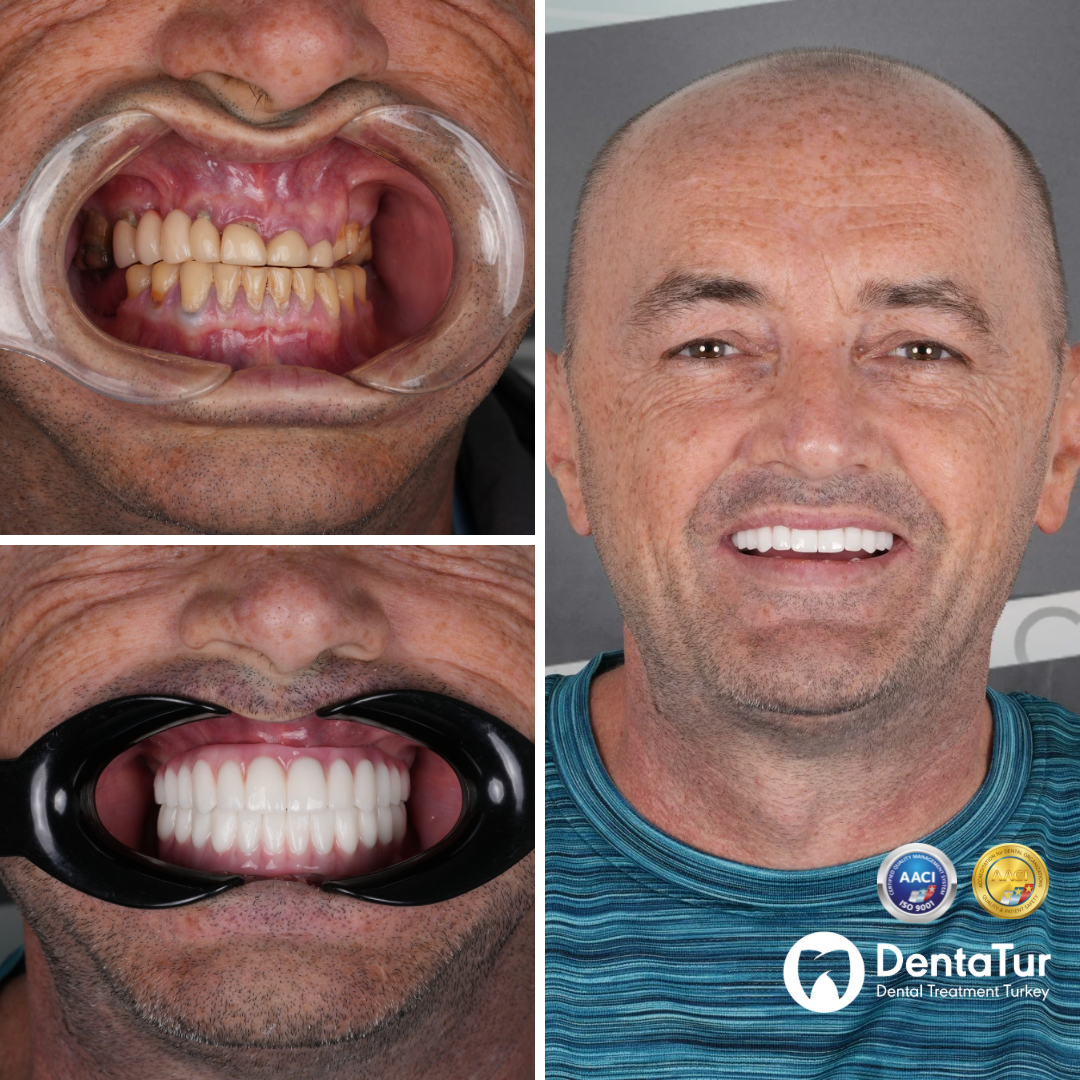 Dental implants before and after photo