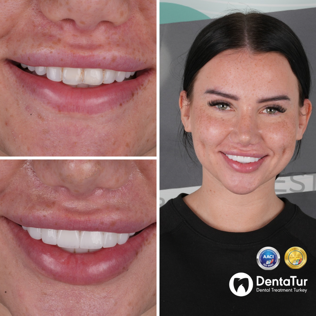 Dental veneers before and after photo