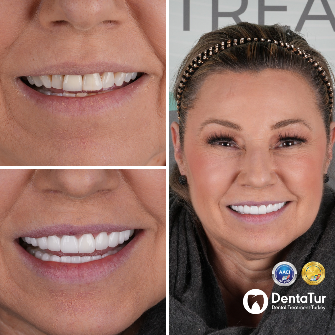 Zirconia crowns before after photo