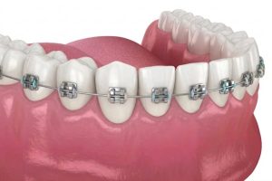 Dental braces in Antalya, Turkey