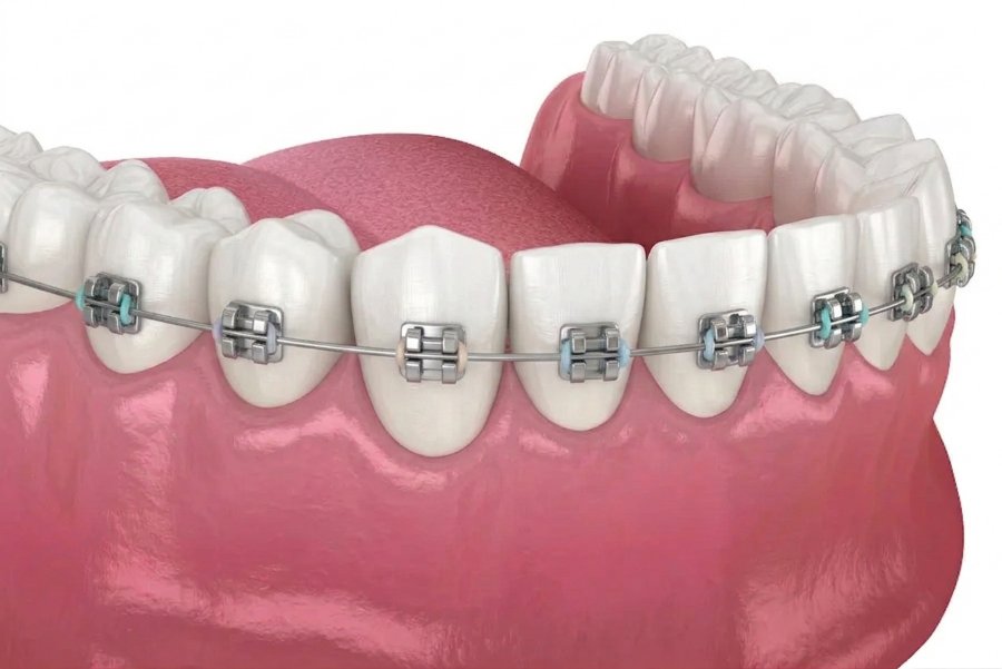 Dental braces in Antalya, Turkey