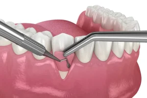 Gum graft surgery in Turkey