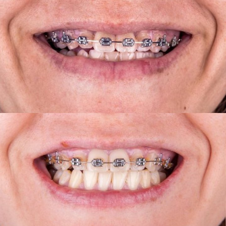 braces in Turkey before-after