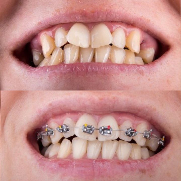 braces in Turkey