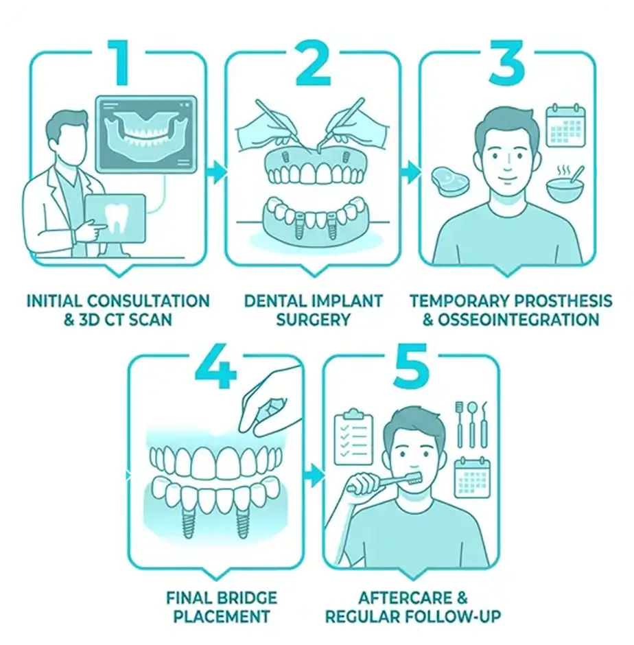All on 8 Dental Implants Procedure Plan Step by Step (1)